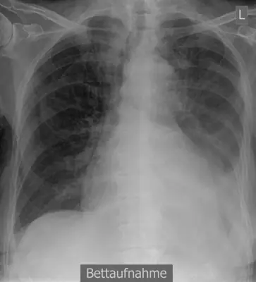 Radiograph from the case bank: Pleural effusion