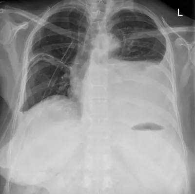 Radiograph from the case bank: Pleural effusion