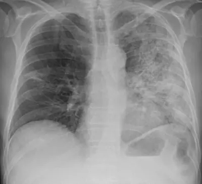 Radiograph from the case bank: Pneumonia (consolidation)