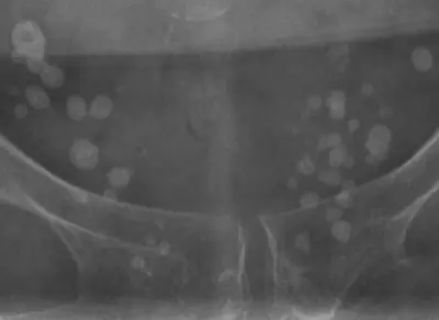 Radiograph from the case bank: Pelvic phleboliths