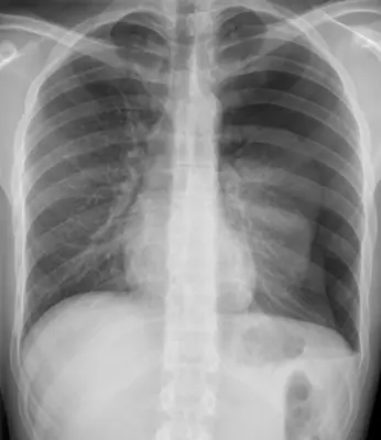 Radiograph from the case bank: Pneumothorax