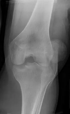 Radiograph from the case bank: Patellar dislocation