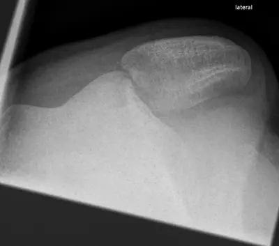Radiograph from the case bank: Patellar dislocation