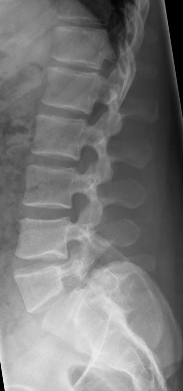 Spine radiograph for self-assessment