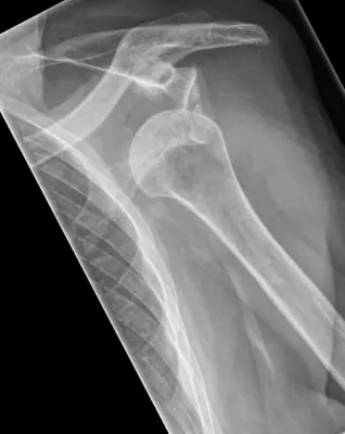 Radiograph from the case bank: Shoulder (glenohumeral) dislocation