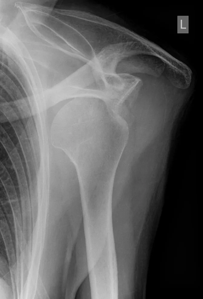 Upper limb radiograph for self-assessment