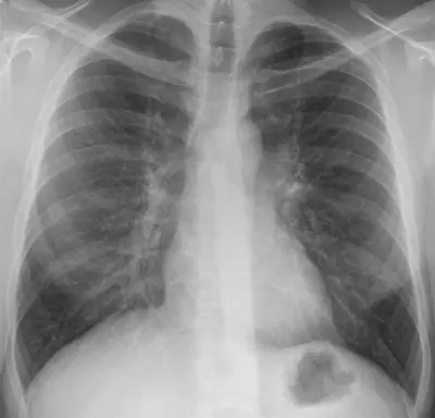Radiograph from the case bank: Normal chest radiograph