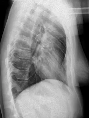 Radiograph from the case bank: Pectus excavatum
