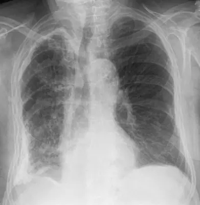 Radiograph from the case bank: Pulmonary tuberculosis