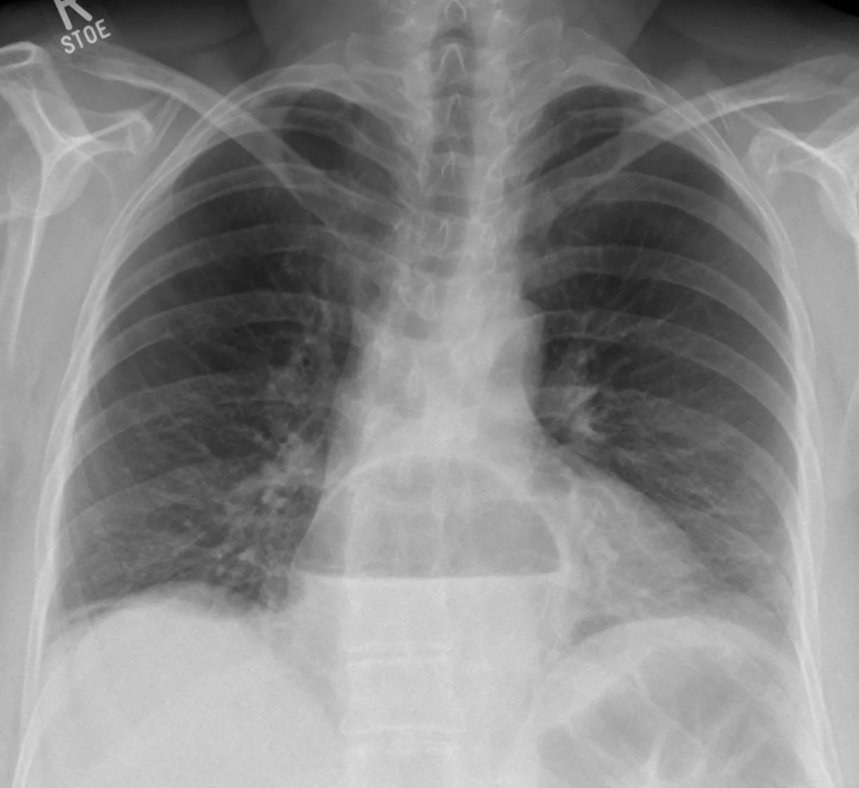 Chest radiograph for self-assessment