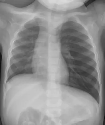 Radiograph from the case bank: Inhaled (aspirated) foreign body