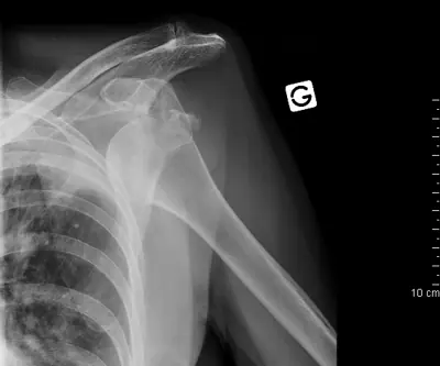 Radiograph from the case bank: Shoulder (glenohumeral) dislocation