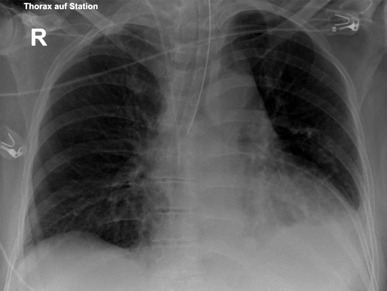 Lines & tubes radiograph for self-assessment