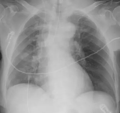 Radiograph from the case bank: Endotracheal tube