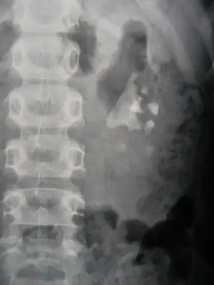 Radiograph from the case bank: Urinary tract calculi (kidney or ureteric stones)