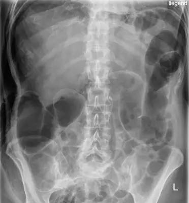 Radiograph from the case bank: Pneumoperitoneum (free intraperitoneal gas)