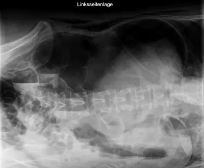 Radiograph from the case bank: Pneumoperitoneum (free intraperitoneal gas)