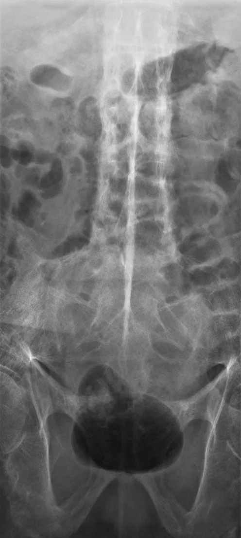 Spine radiograph for self-assessment