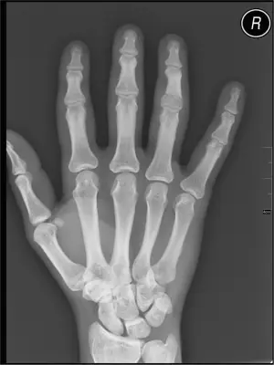Radiograph from the case bank: Finger (phalangeal) fracture