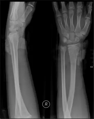 Radiograph from the case bank: Distal radius fracture