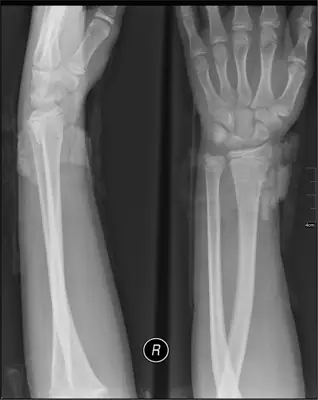 Radiograph from the case bank: Distal radius fracture