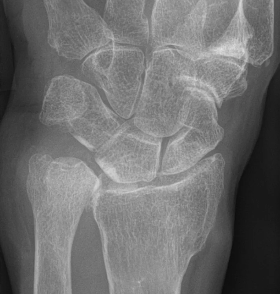 Upper limb radiograph for self-assessment