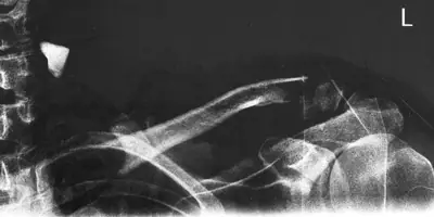 Radiograph from the case bank: Clavicle fracture