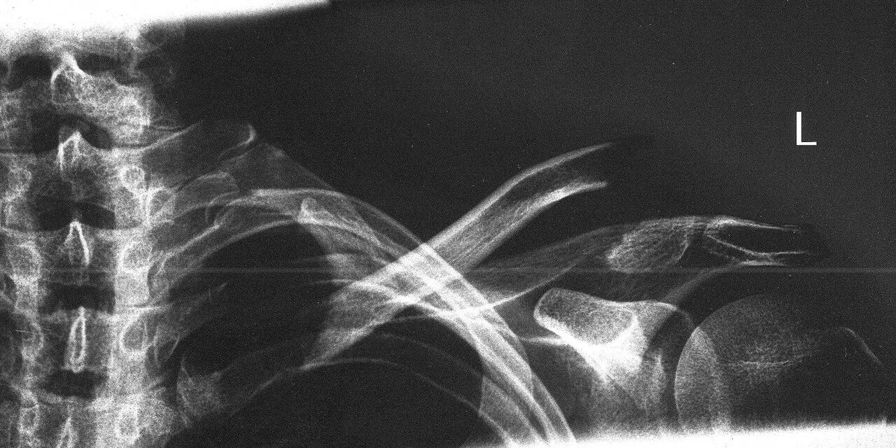 Upper limb radiograph for self-assessment