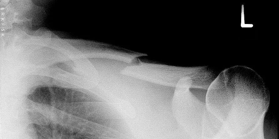 Upper limb radiograph for self-assessment