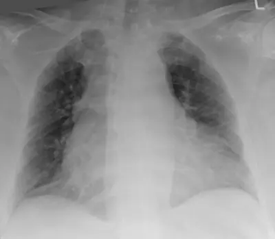 Radiograph from the case bank: Central venous catheter