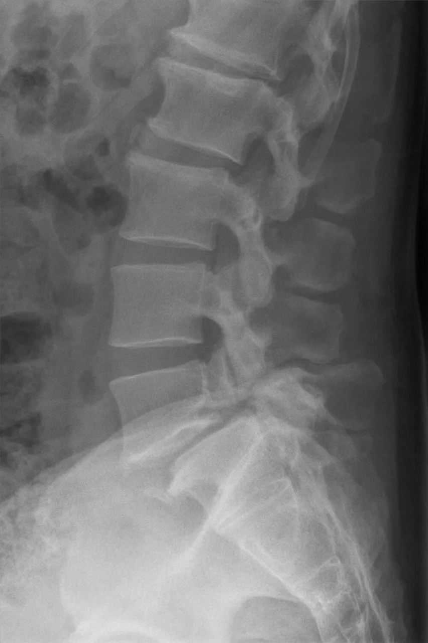 Spine radiograph for self-assessment