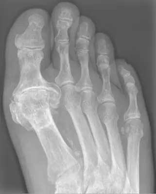 Radiograph from the case bank: Hallux rigidus (first MTP osteoarthritis)