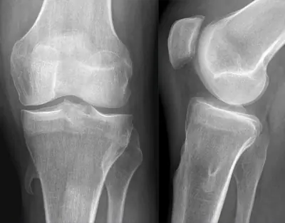 Radiograph from the case bank: Osteochondroma (exostosis)