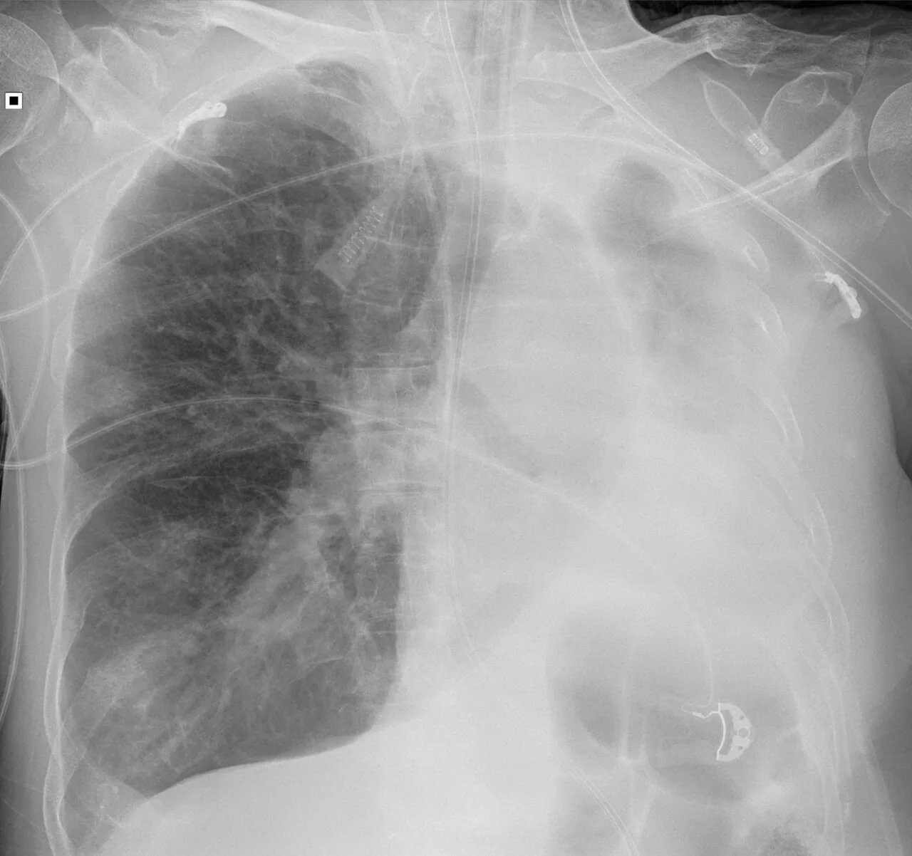 Chest radiograph for self-assessment