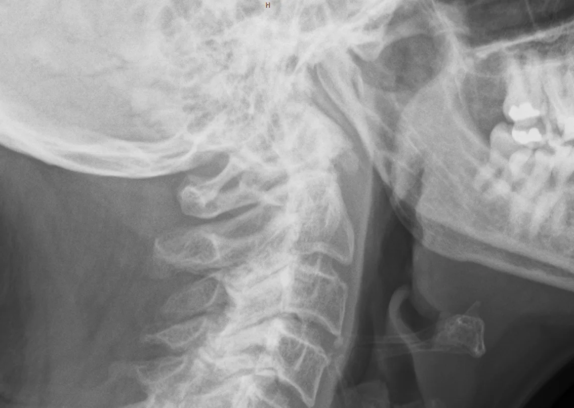 Spine radiograph for self-assessment