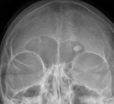 Radiograph from the case bank: Osteoma