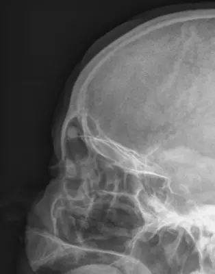 Radiograph from the case bank: Osteoma