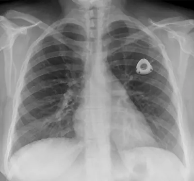 Radiograph from the case bank: Implanted venous access port (port-a-cath)