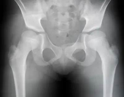 Radiograph from the case bank: Developmental dysplasia of the hip (DDH)