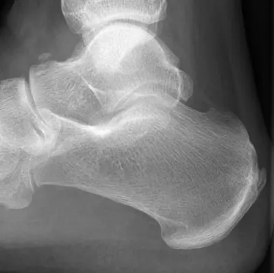 Radiograph from the case bank: Calcaneal spur
