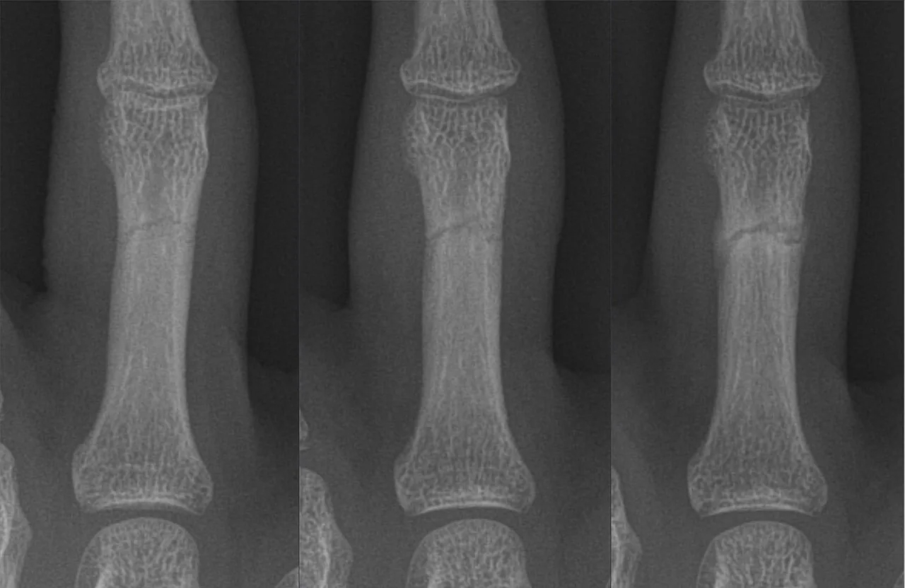 Upper limb radiograph for self-assessment
