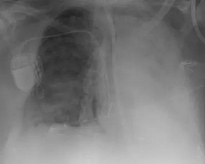 Radiograph from the case bank: Endotracheal tube