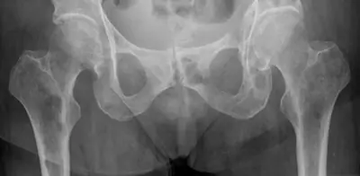 Radiograph from the case bank: Bone metastases