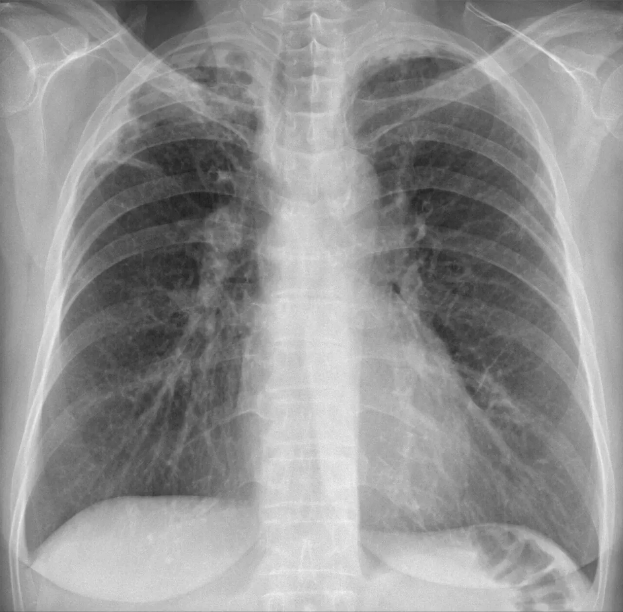 Chest radiograph for self-assessment