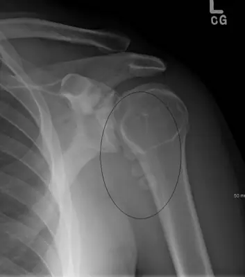 Radiograph from the case bank: Acromioclavicular joint dislocation