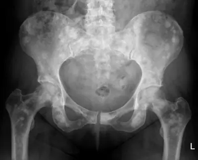 Radiograph from the case bank: Bone metastases