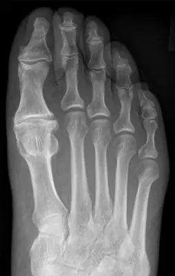 Radiograph from the case bank: Hallux rigidus (first MTP osteoarthritis)