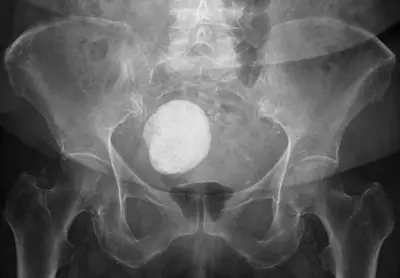 Radiograph from the case bank: Calcified uterine fibroid