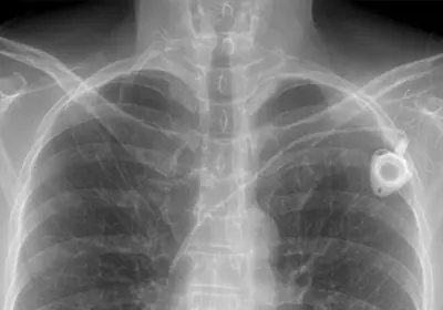 Radiograph from the case bank: Cervical rib