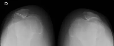Radiograph from the case bank: Knee osteoarthritis